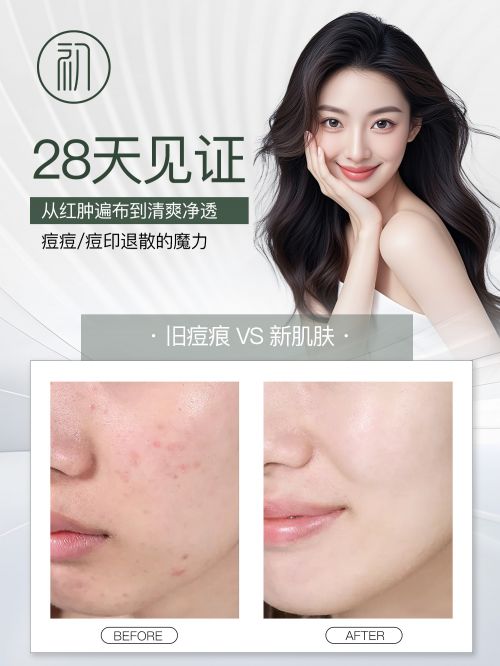 十大高分好评祛痘品牌效果显著开元棋牌app认证的祛痘产品(图2)